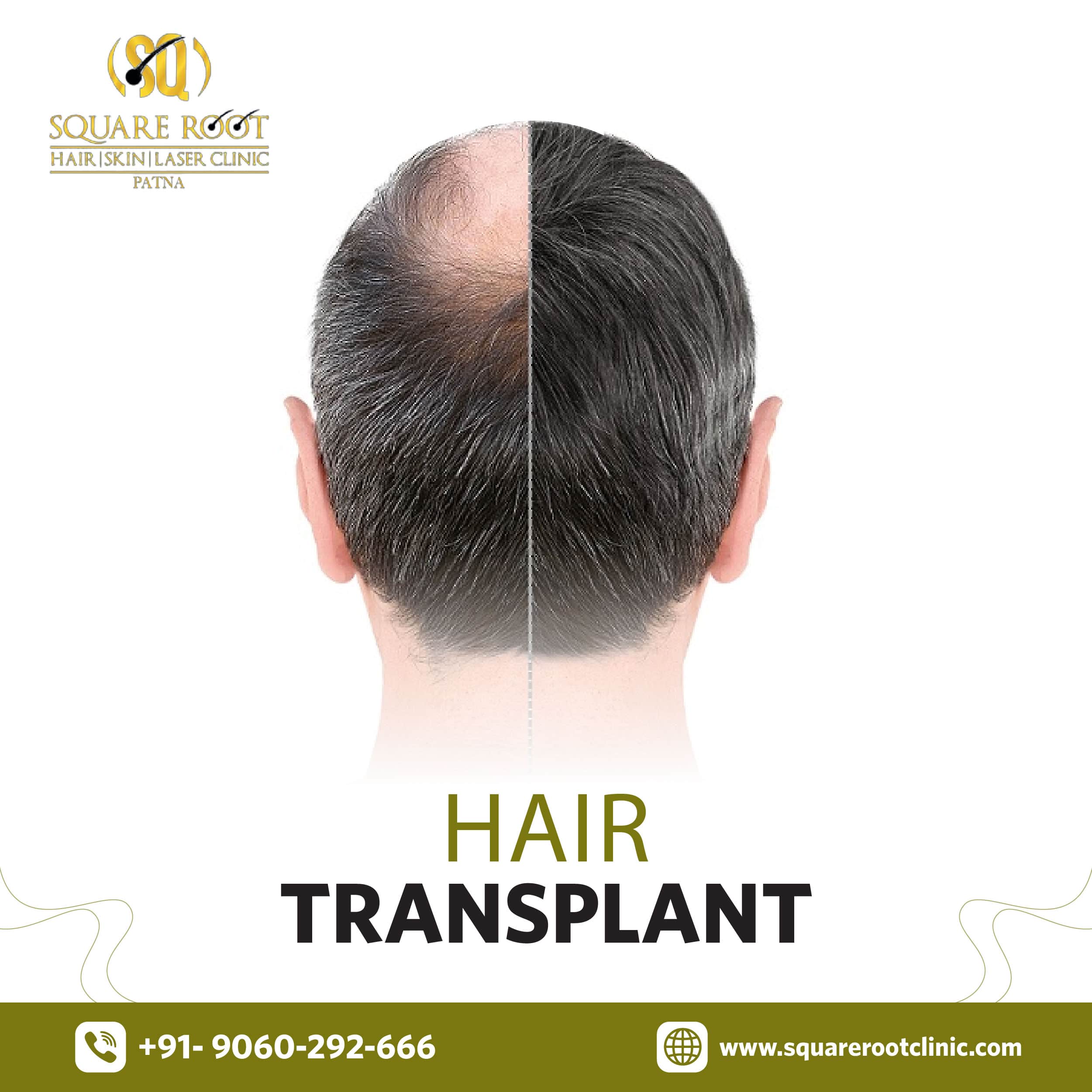 Hair Transplant in Patna