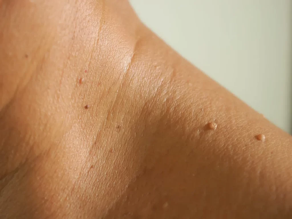 Wart Removal in Patna
