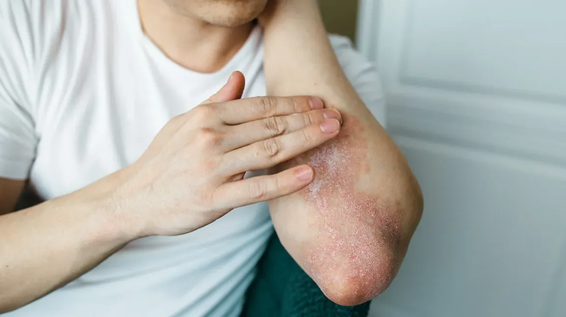 psoriasis