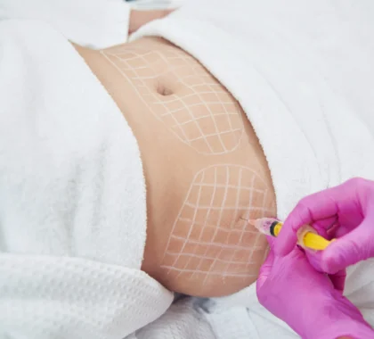Lipolysis Injection Treatment